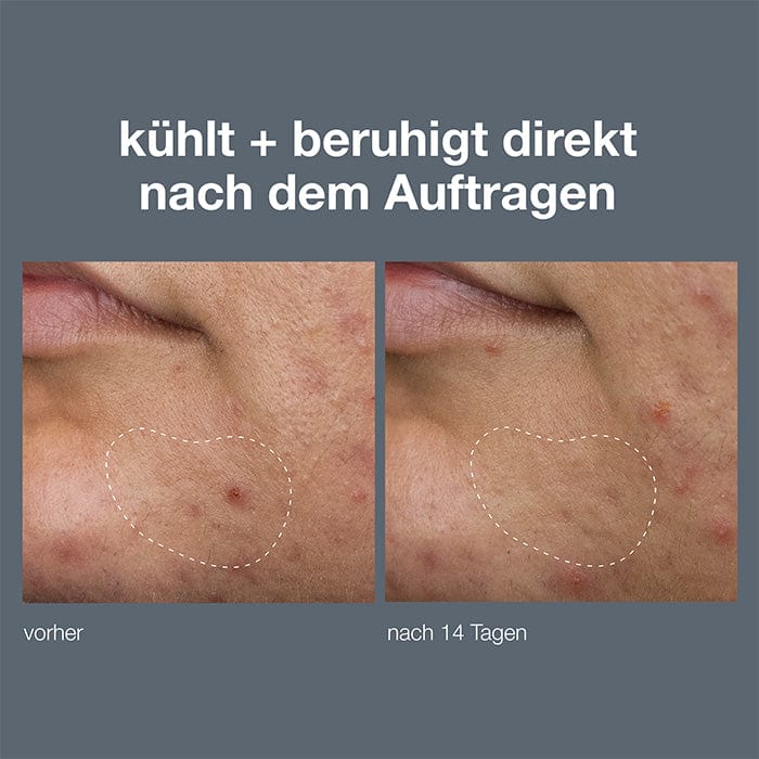 Dermalogica Deep Breakout Liquid Patch – Serum